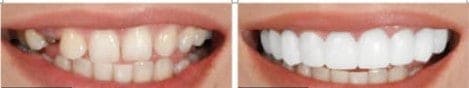 Carillas Dentales Postizas - Superiores y inferiores
